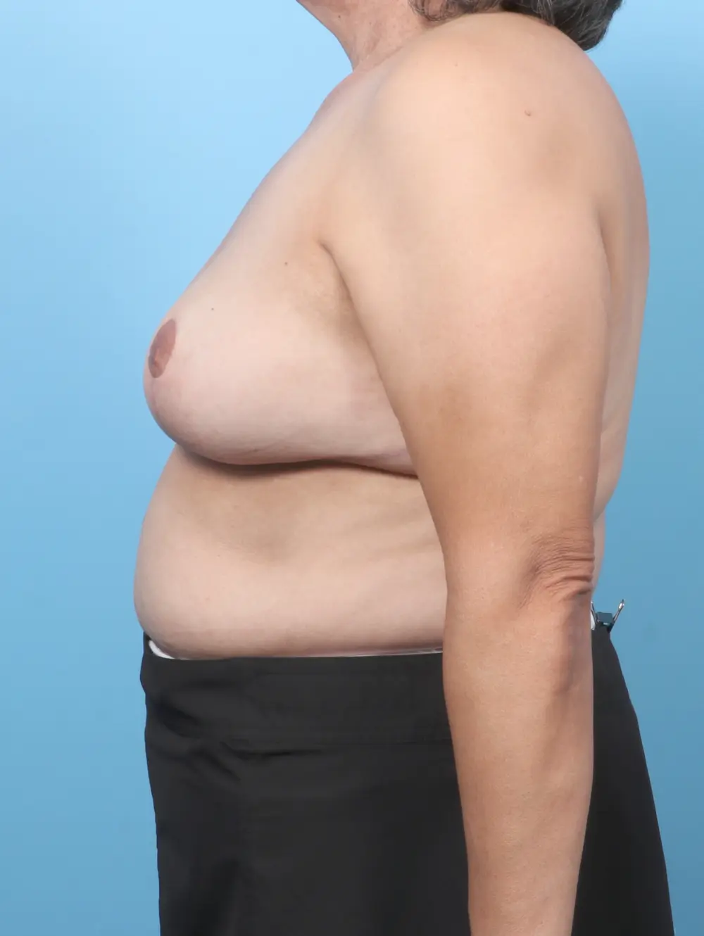 Breast Implant Removal Patient Photo - Case 59532 - after view-2