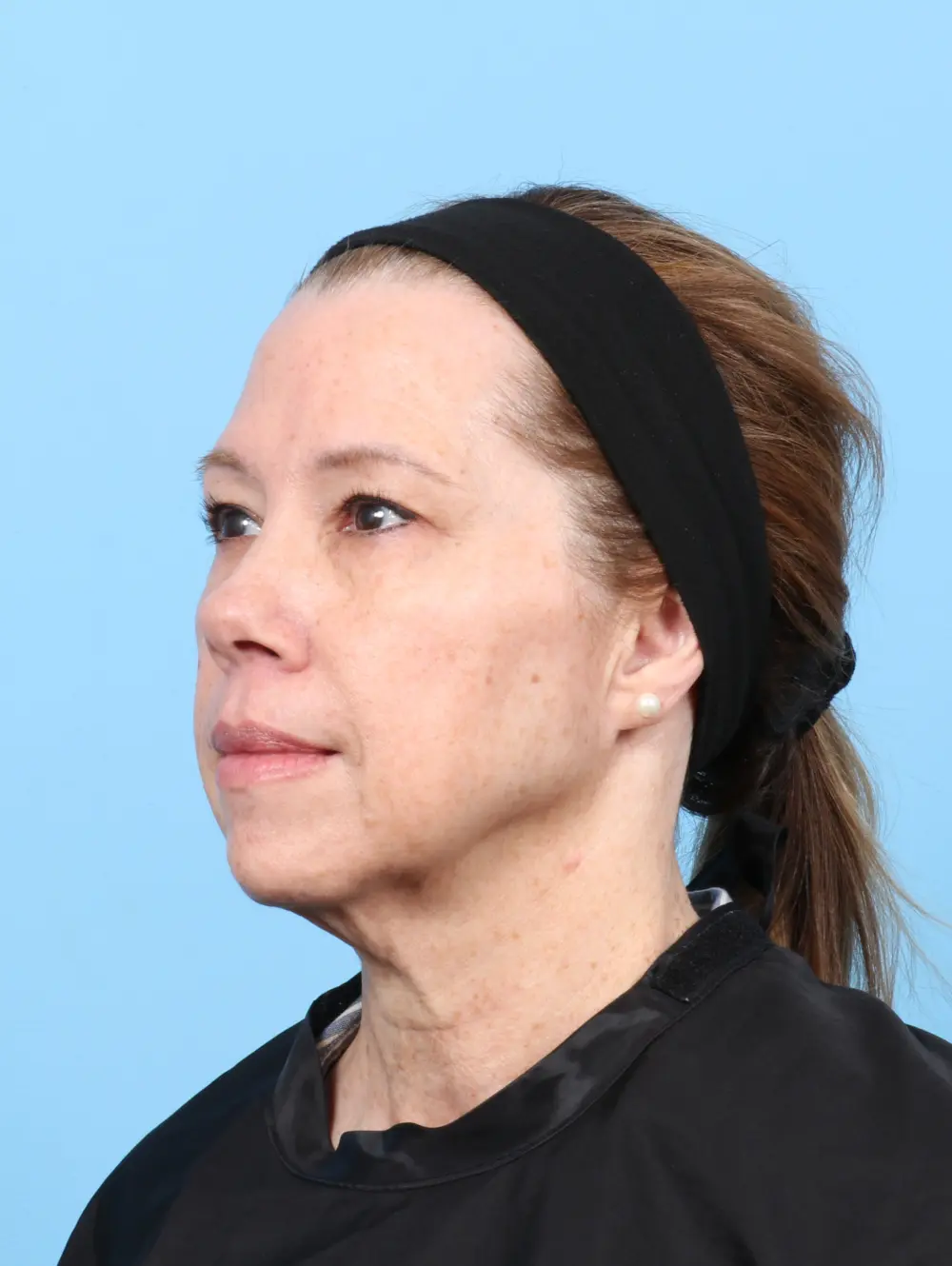 Eyelid Surgery Patient Photo - Case 59554 - before view-1