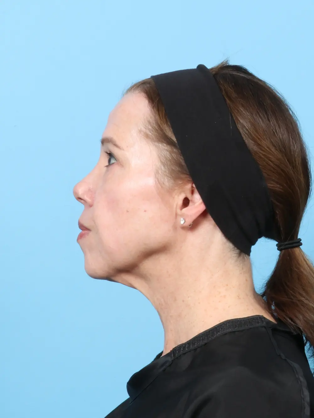 Eyelid Surgery Patient Photo - Case 59554 - after view-2