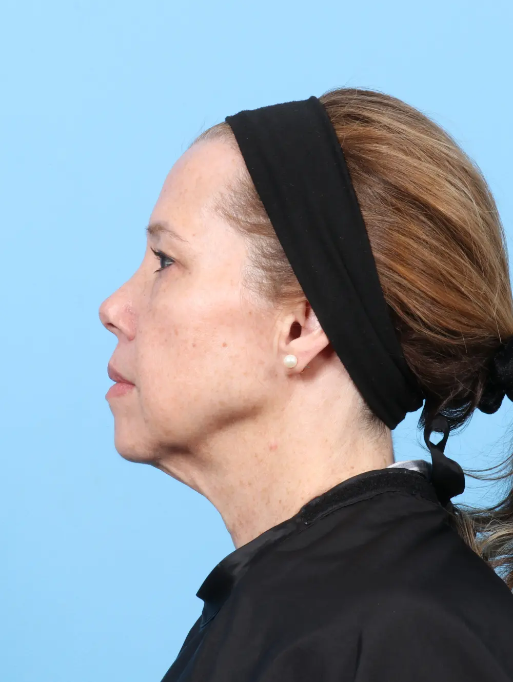 Eyelid Surgery Patient Photo - Case 59554 - before view-2