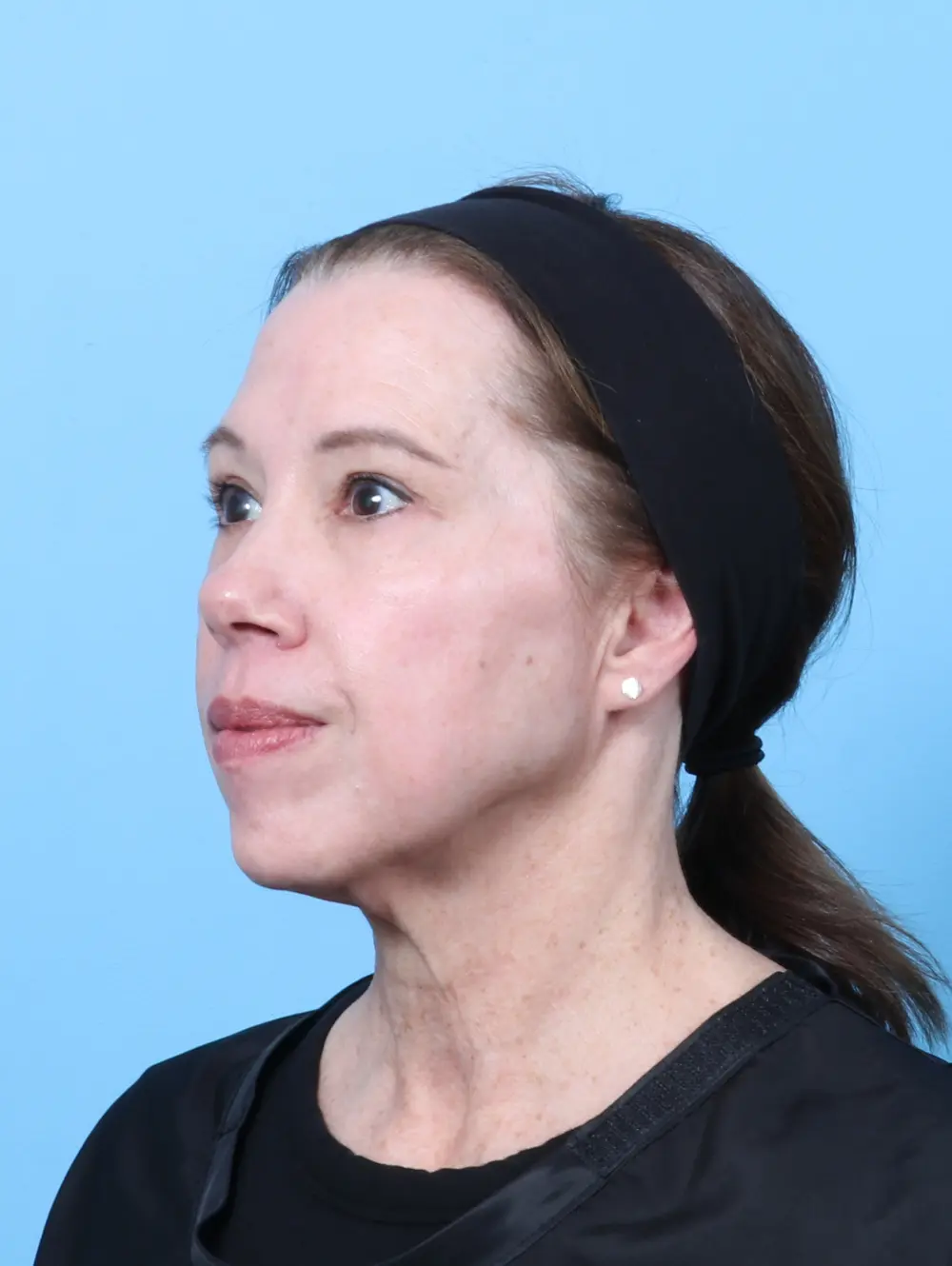 Eyelid Surgery Patient Photo - Case 59554 - after view-1