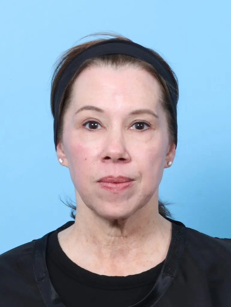 Eyelid Surgery - Case 59554 - After