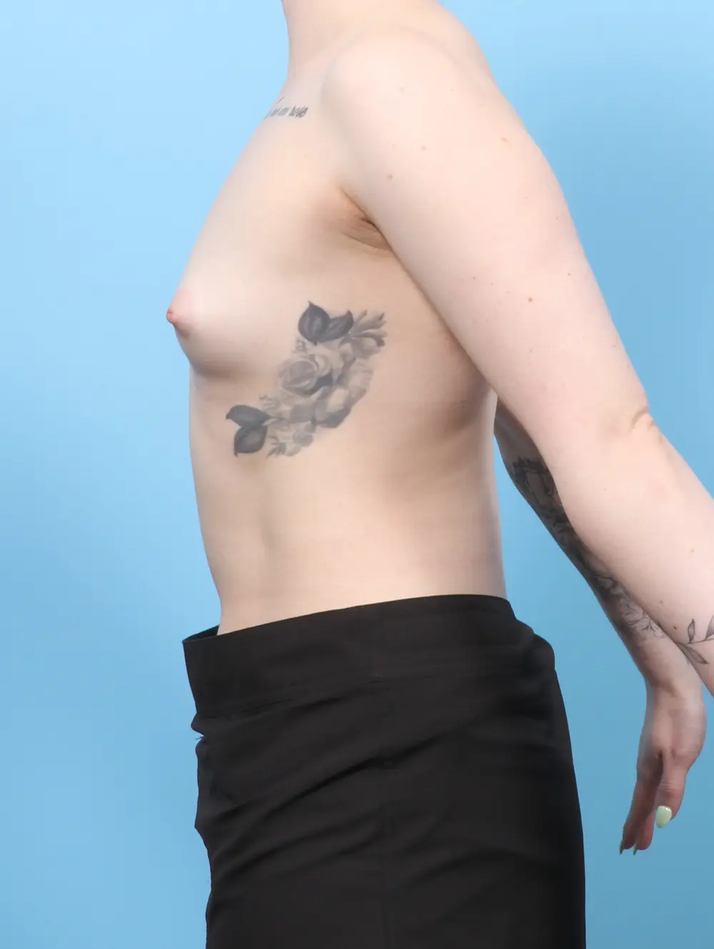 Breast Augmentation Patient Photo - Case 59579 - before view-2