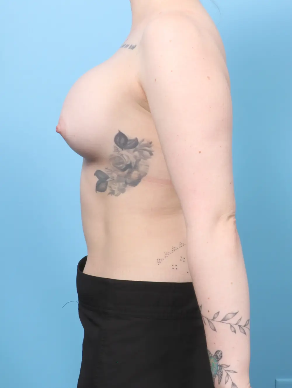 Breast Augmentation Patient Photo - Case 59579 - after view-2