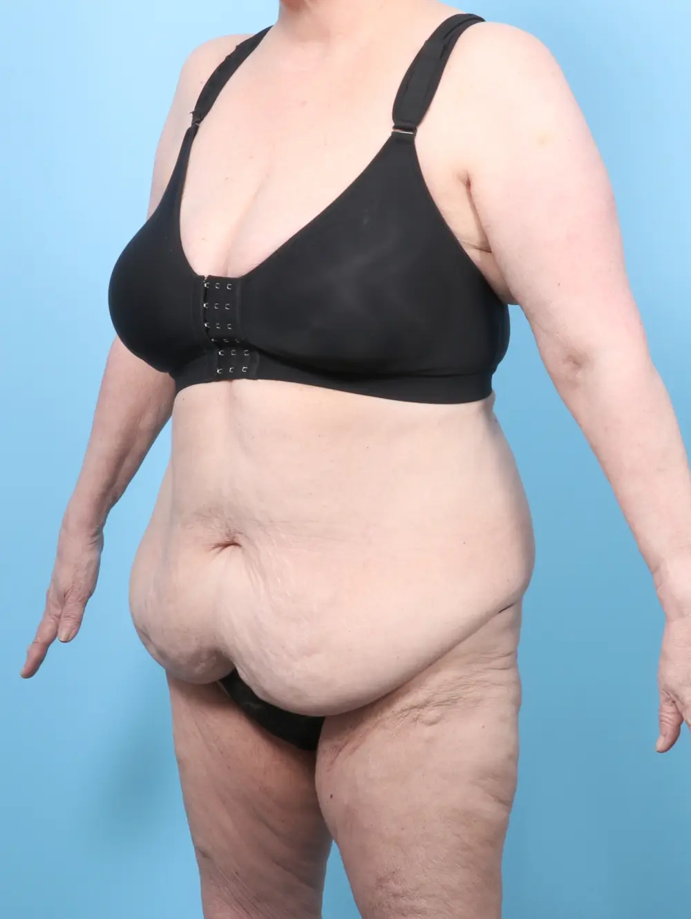 Tummy Tuck Patient Photo - Case 59587 - before view-1