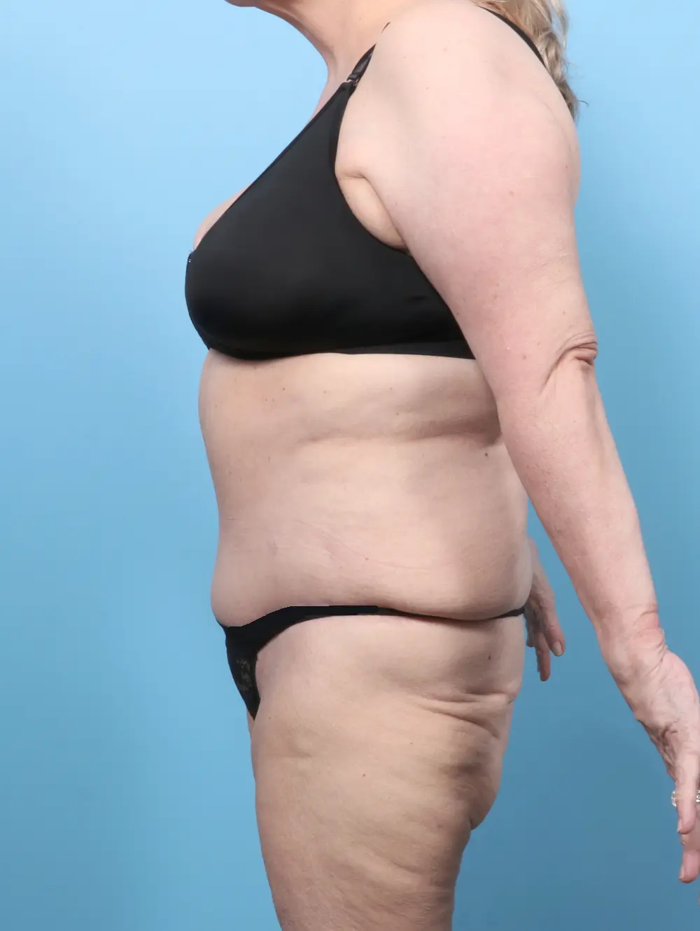 Tummy Tuck Patient Photo - Case 59587 - after view-2