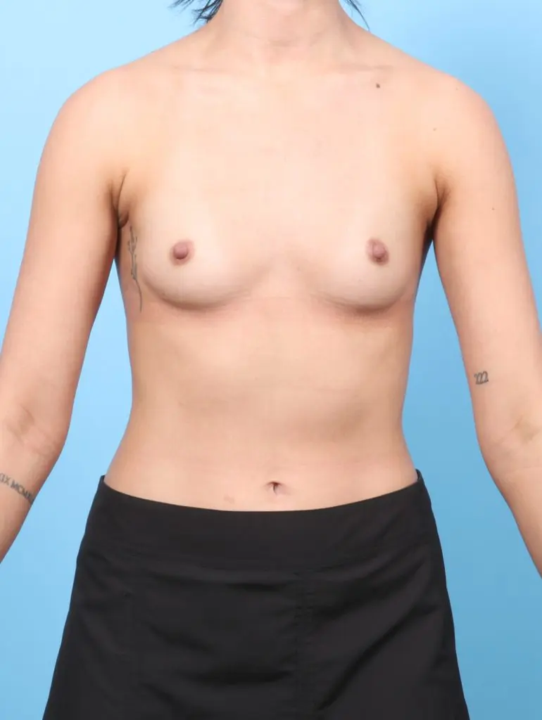 Breast Augmentation - Case 59603 - Before