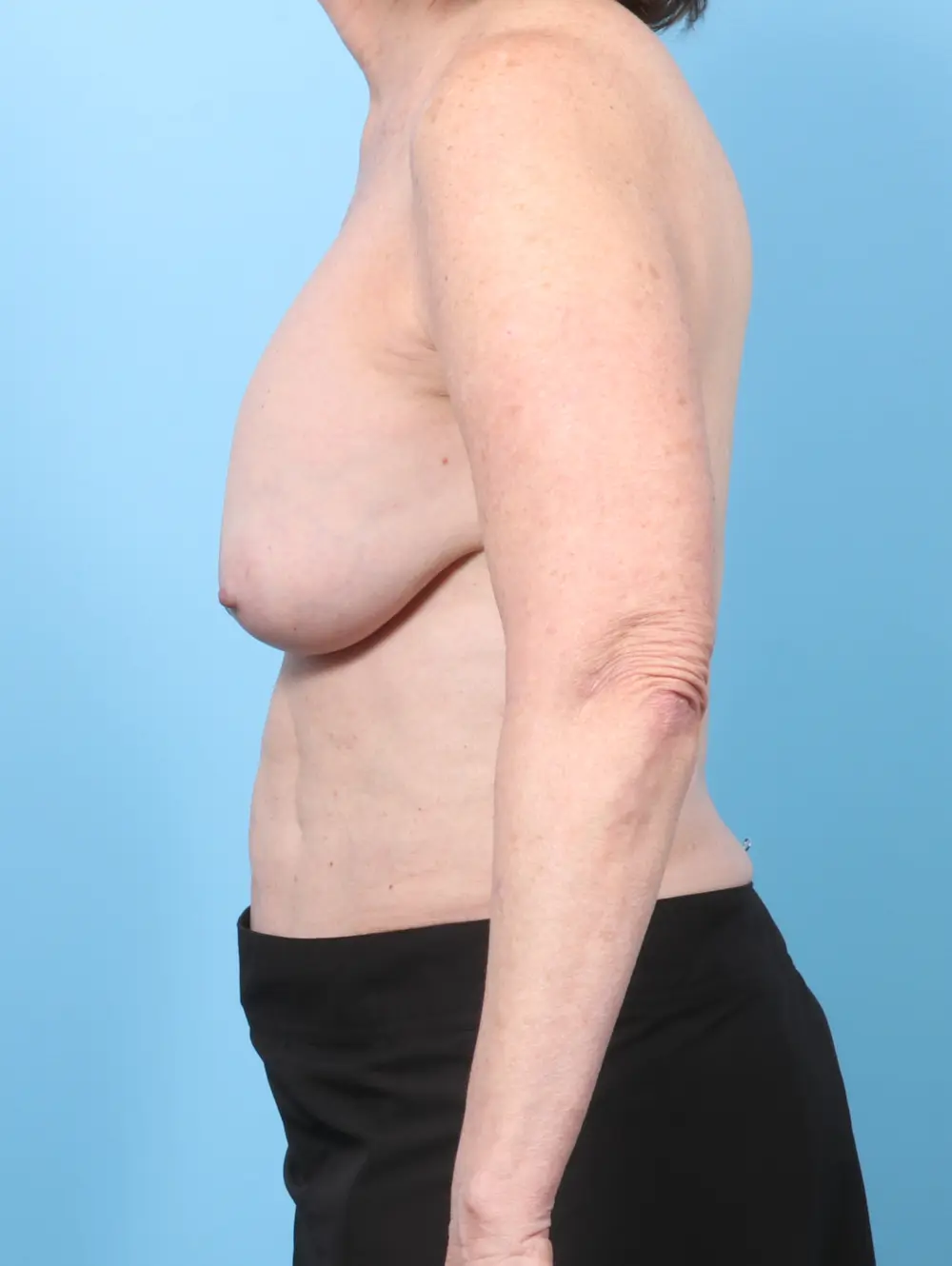 Breast Implant Revision Patient Photo - Case 59628 - before view-2