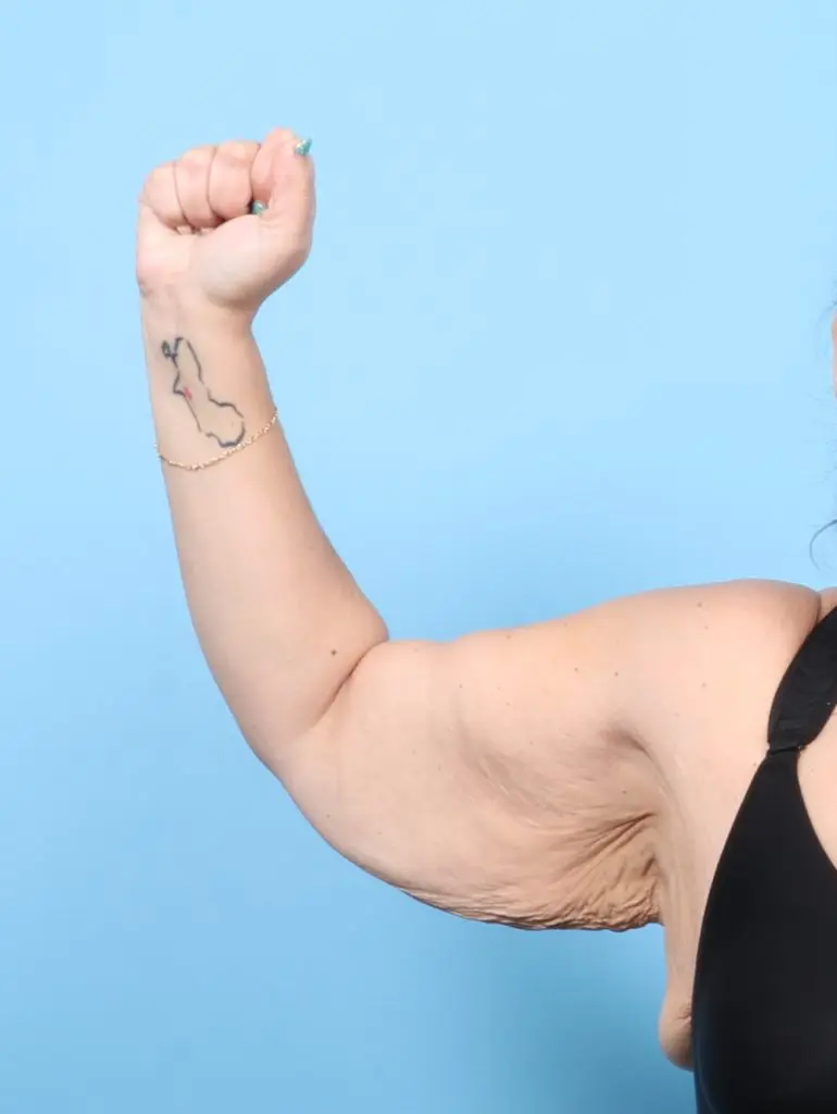 After Weight Loss - Case 59637 - Before