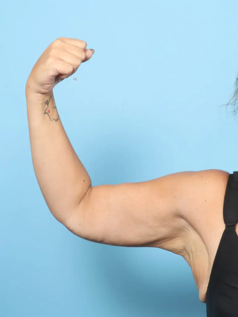 After Weight Loss - Case 59637 - After