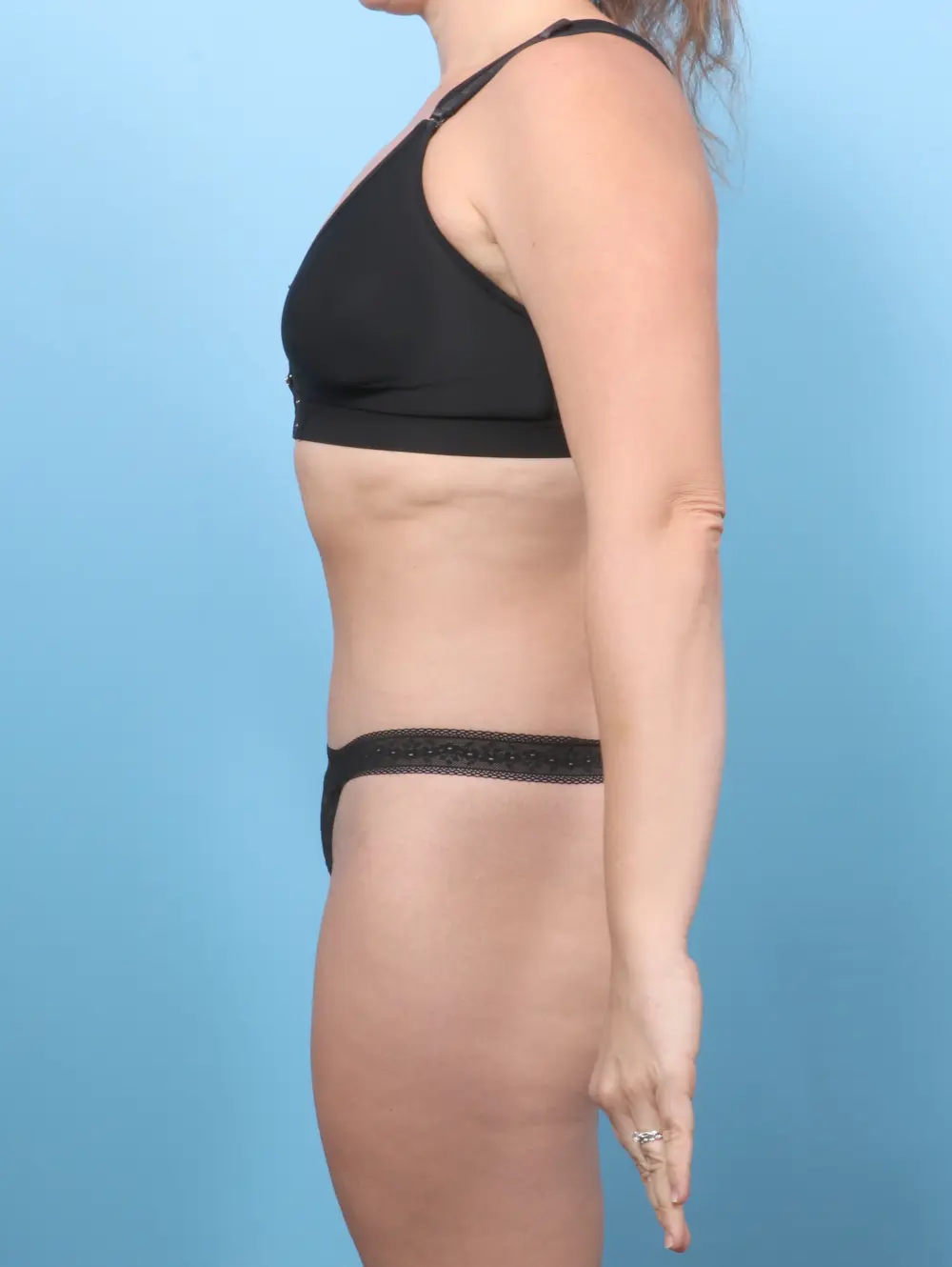 Tummy Tuck Patient Photo - Case 59651 - after view-2