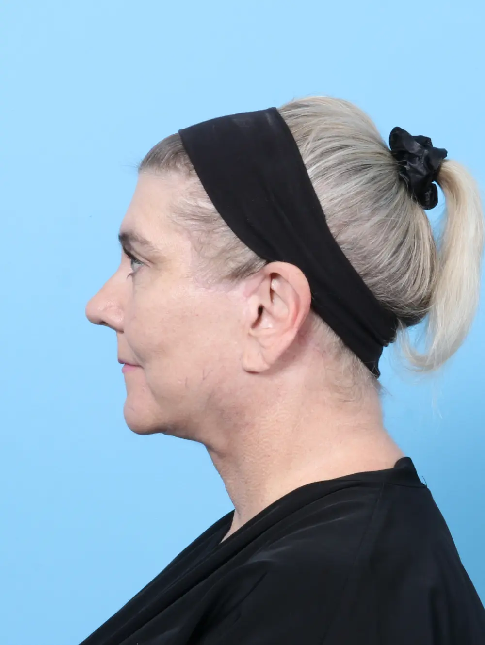 Bullhorn Lip Lift Patient Photo - Case 59713 - after view-2