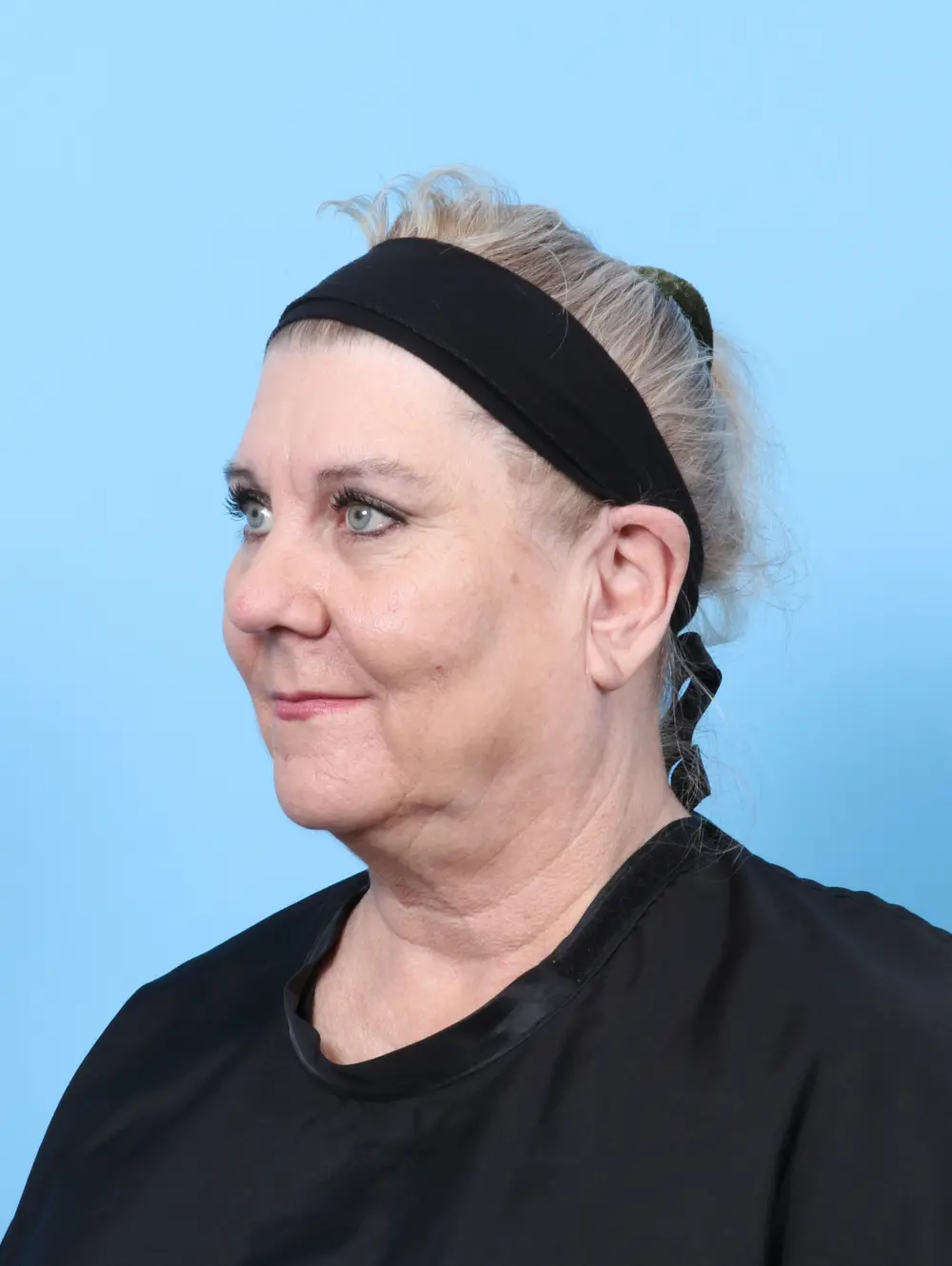 Bullhorn Lip Lift Patient Photo - Case 59713 - before view-1