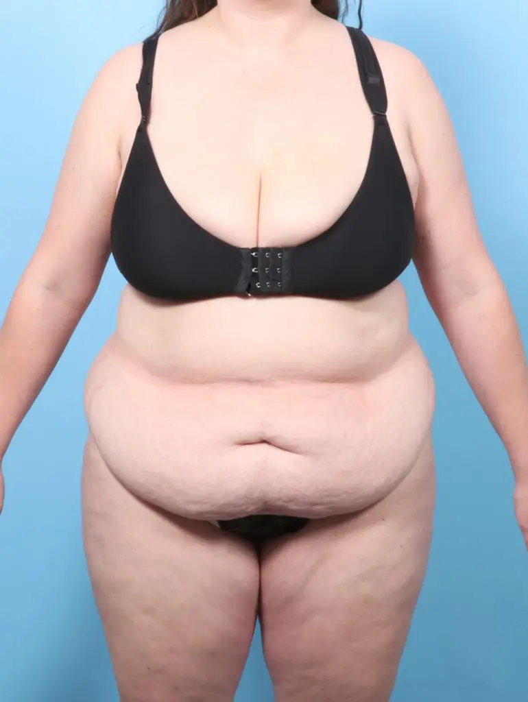 Tummy Tuck - Case 59721 - Before