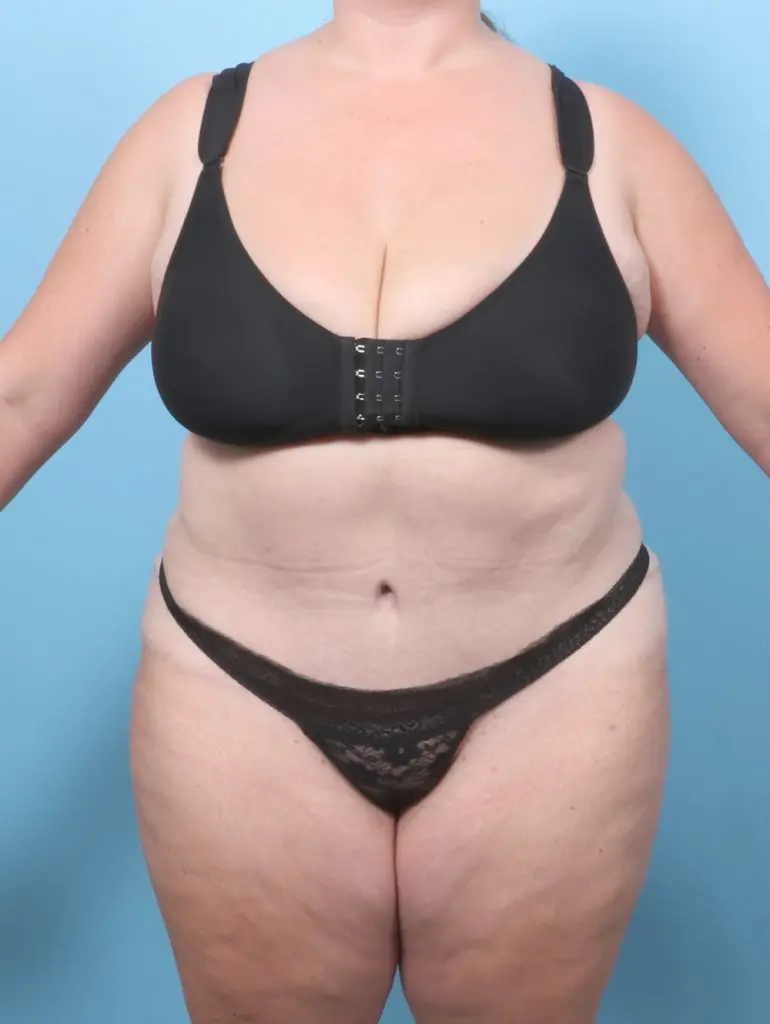 Tummy Tuck - Case 59721 - After