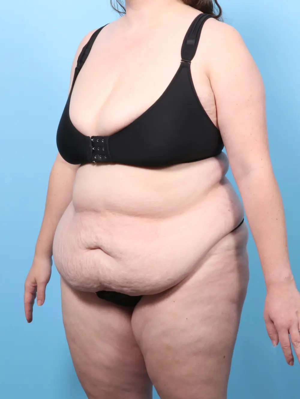 Tummy Tuck Patient Photo - Case 59721 - before view-1