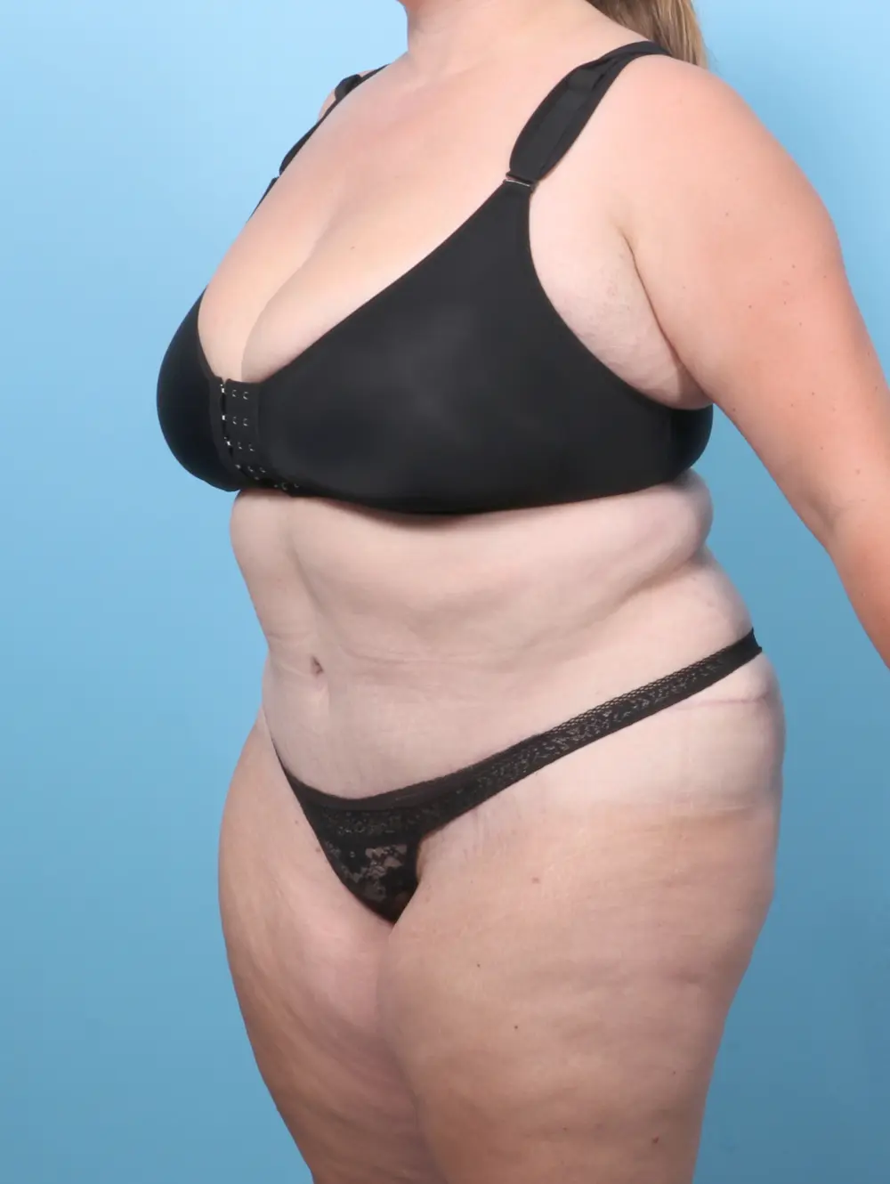Tummy Tuck Patient Photo - Case 59721 - after view-1
