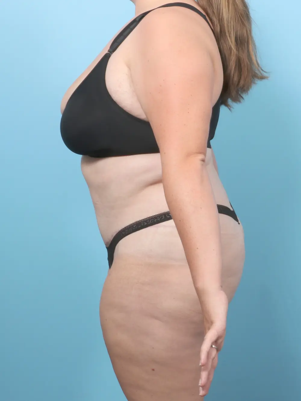 Tummy Tuck Patient Photo - Case 59721 - after view-2