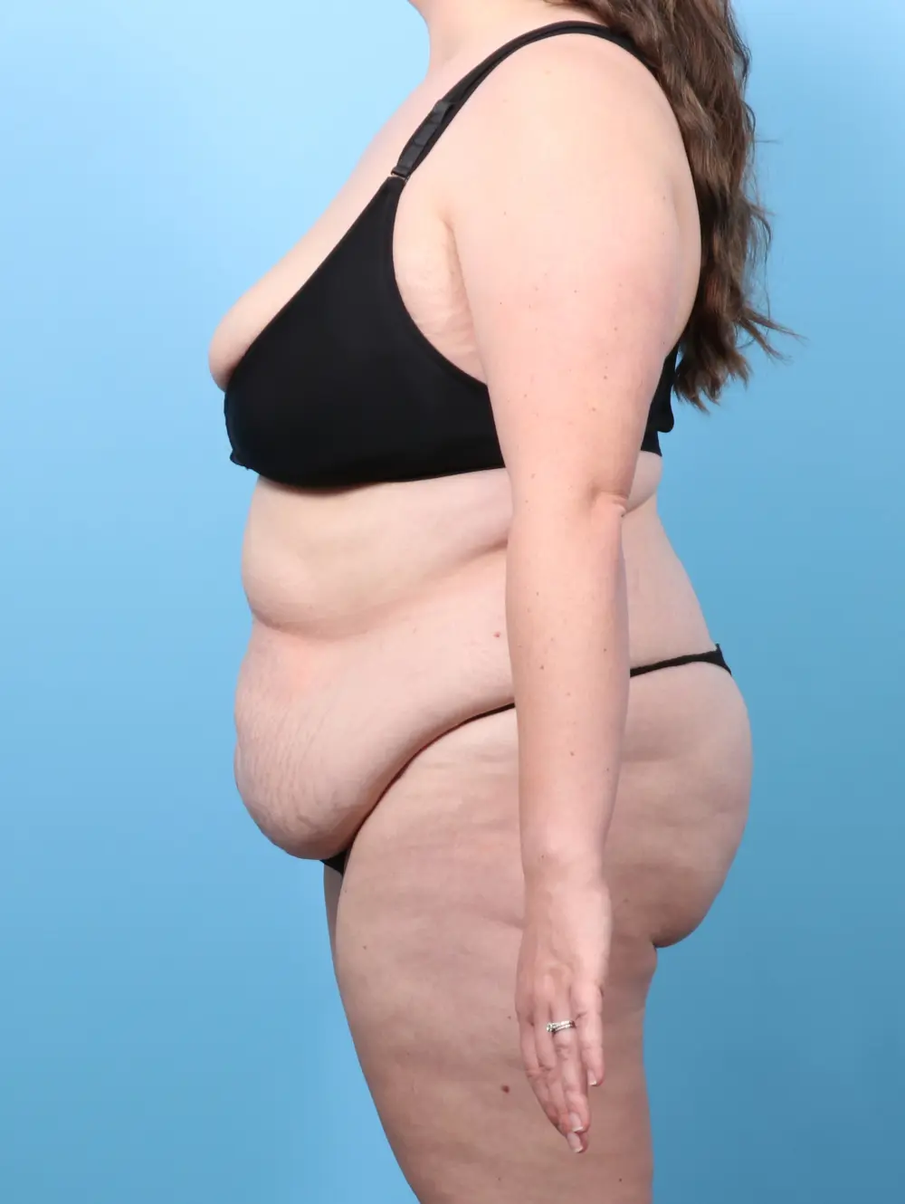 Tummy Tuck Patient Photo - Case 59721 - before view-2