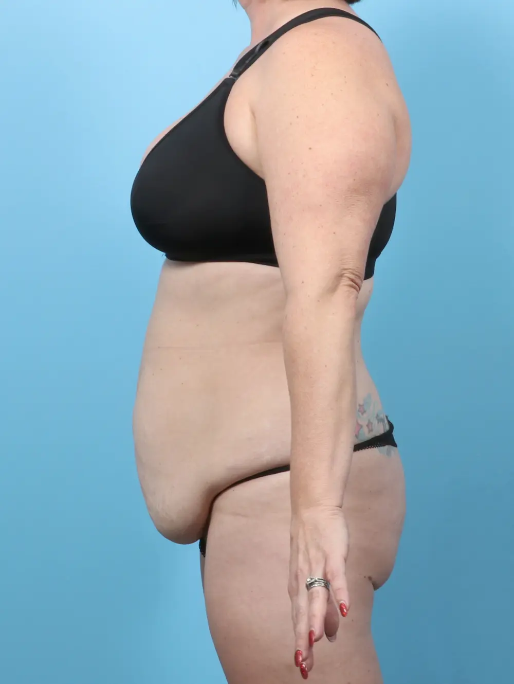 Tummy Tuck Patient Photo - Case 59729 - before view-2