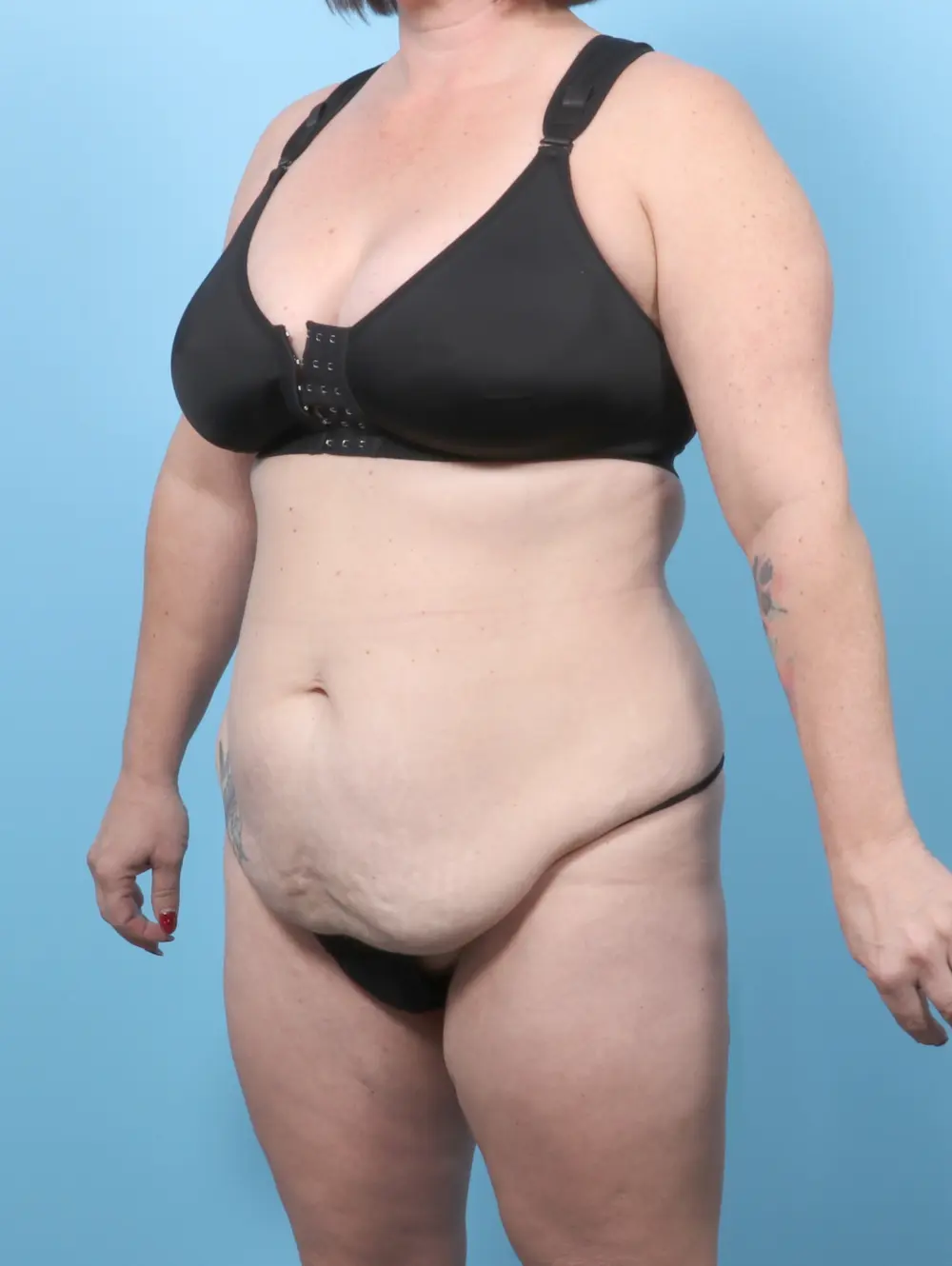 Tummy Tuck Patient Photo - Case 59729 - before view-1