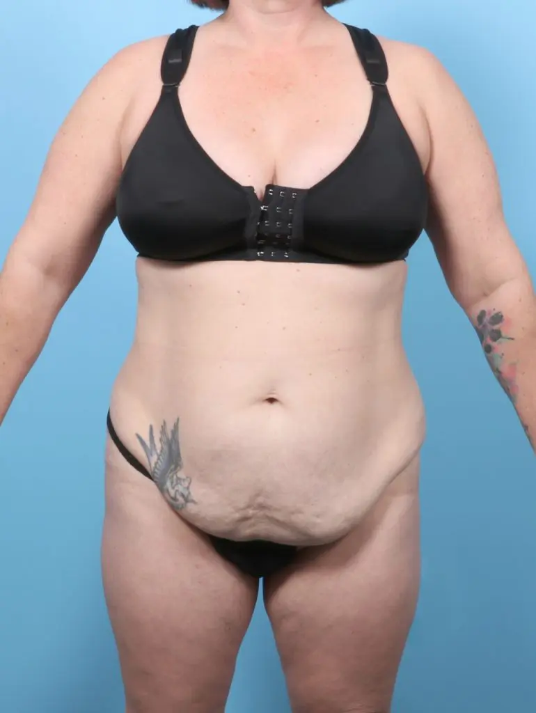 Tummy Tuck - Case 59729 - Before