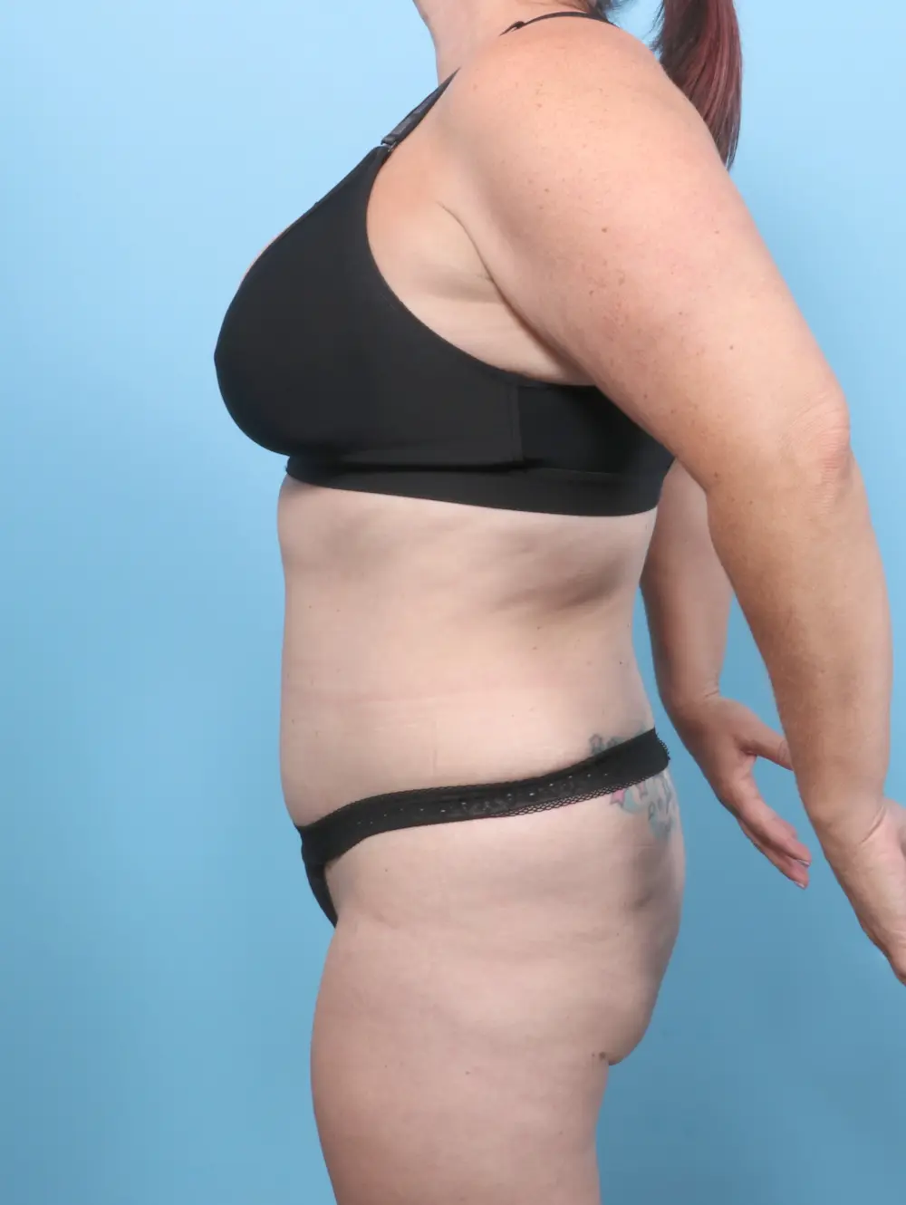 Tummy Tuck Patient Photo - Case 59729 - after view-2