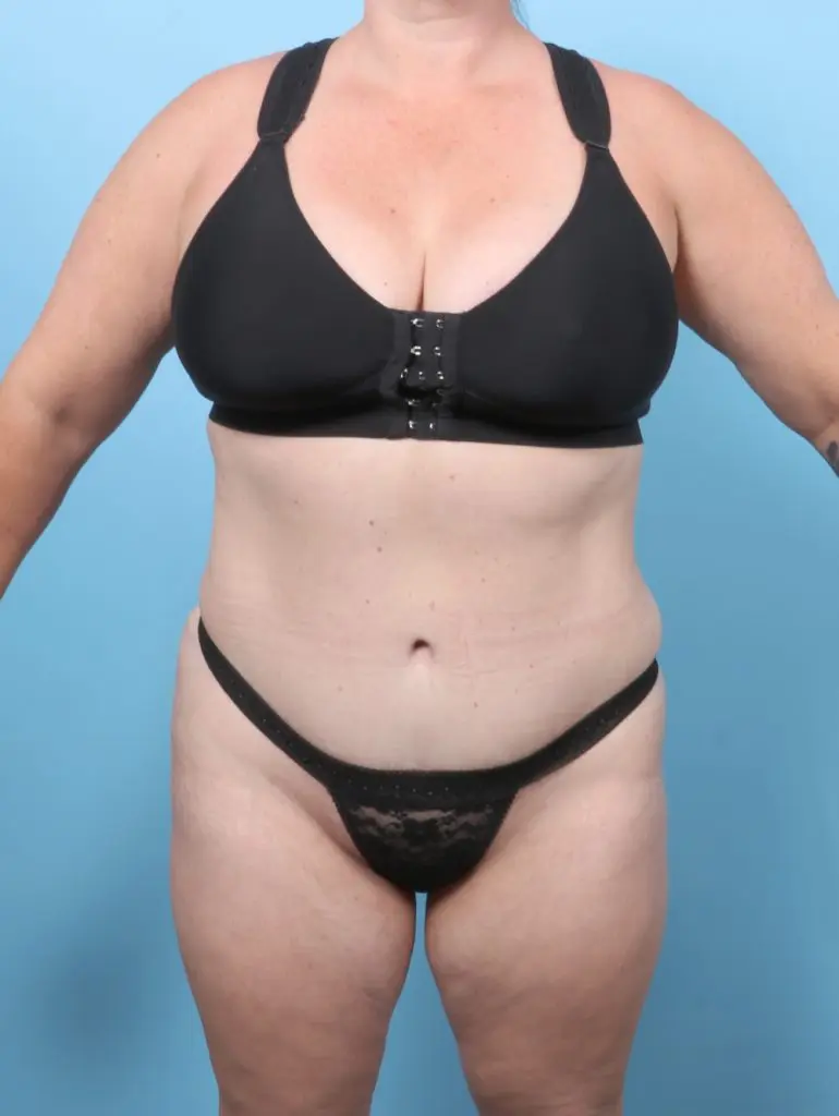 Tummy Tuck - Case 59729 - After