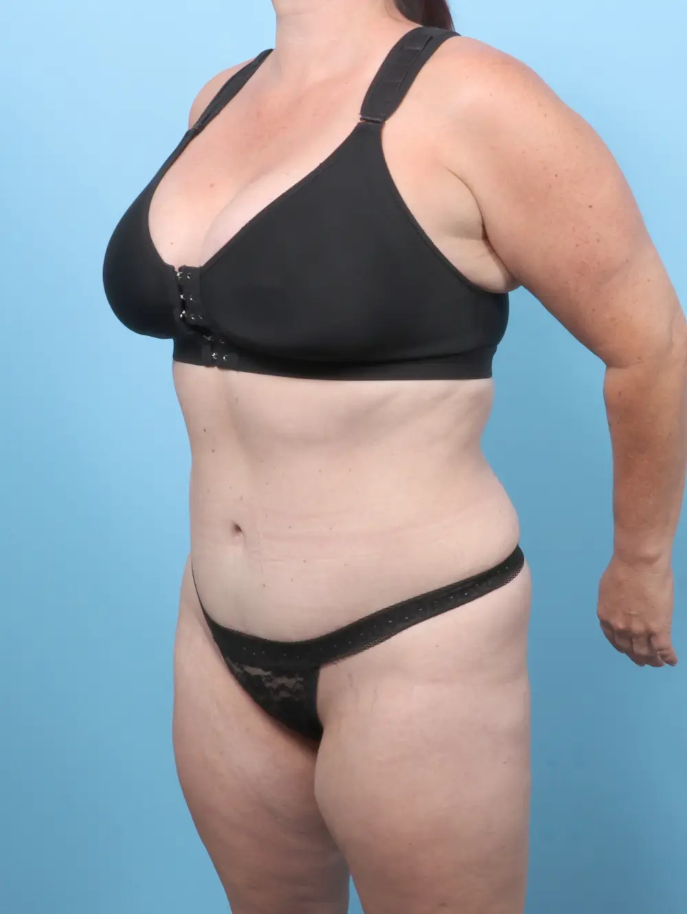Tummy Tuck Patient Photo - Case 59729 - after view-1
