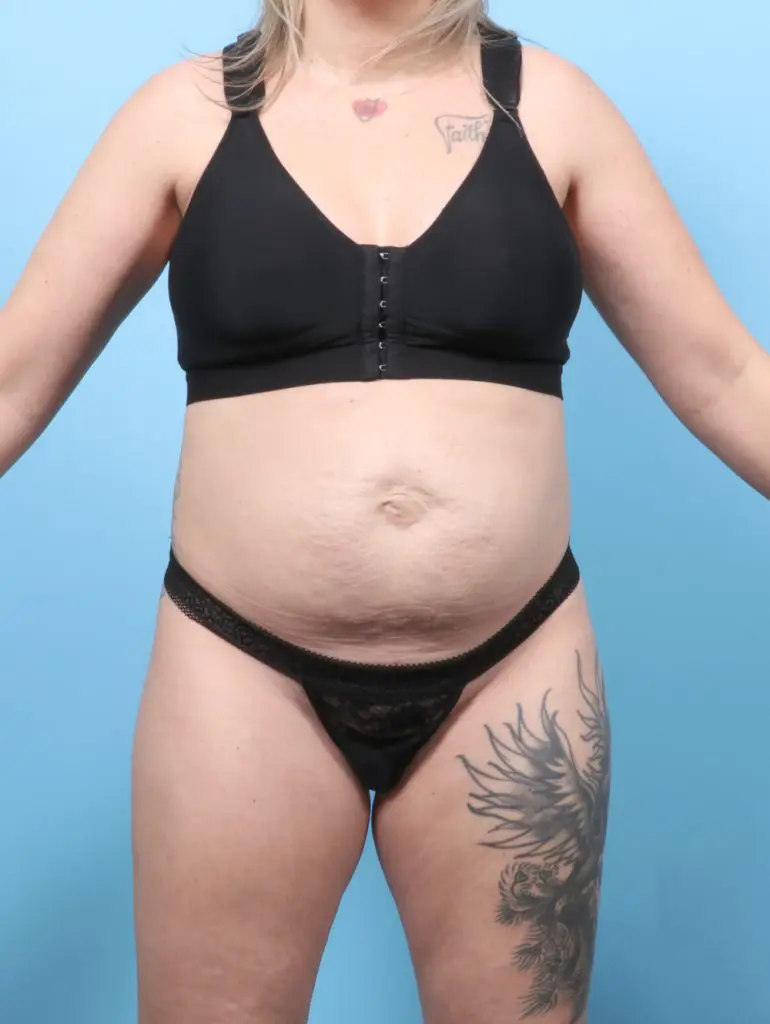 Tummy Tuck - Case 59737 - Before