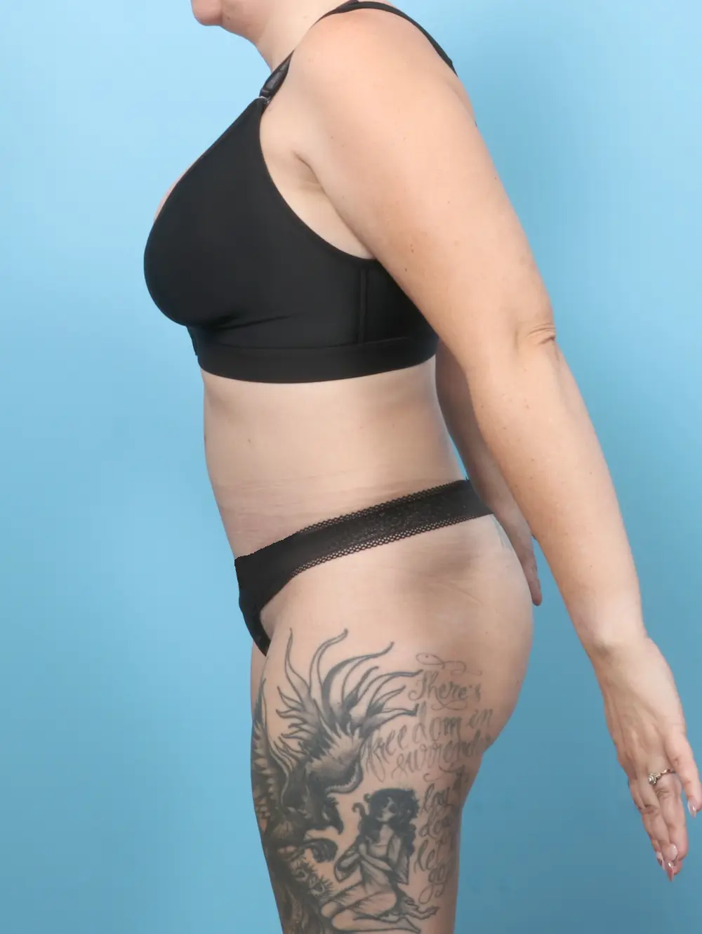 Tummy Tuck Patient Photo - Case 59737 - after view-2