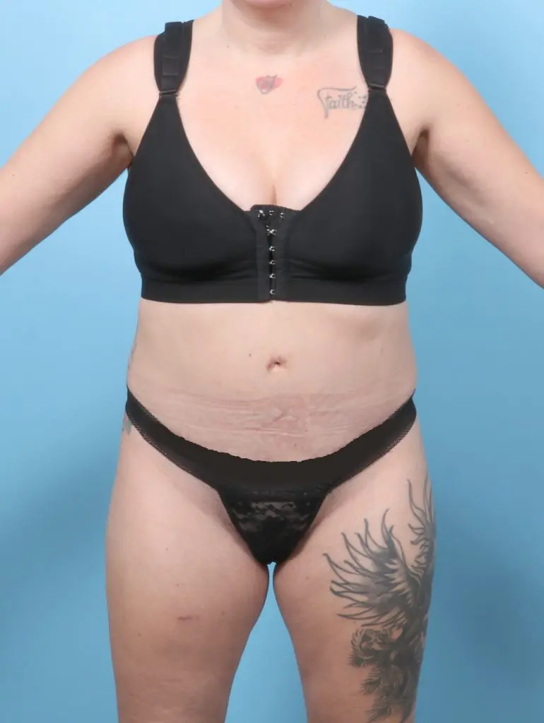 Tummy Tuck - Case 59737 - After