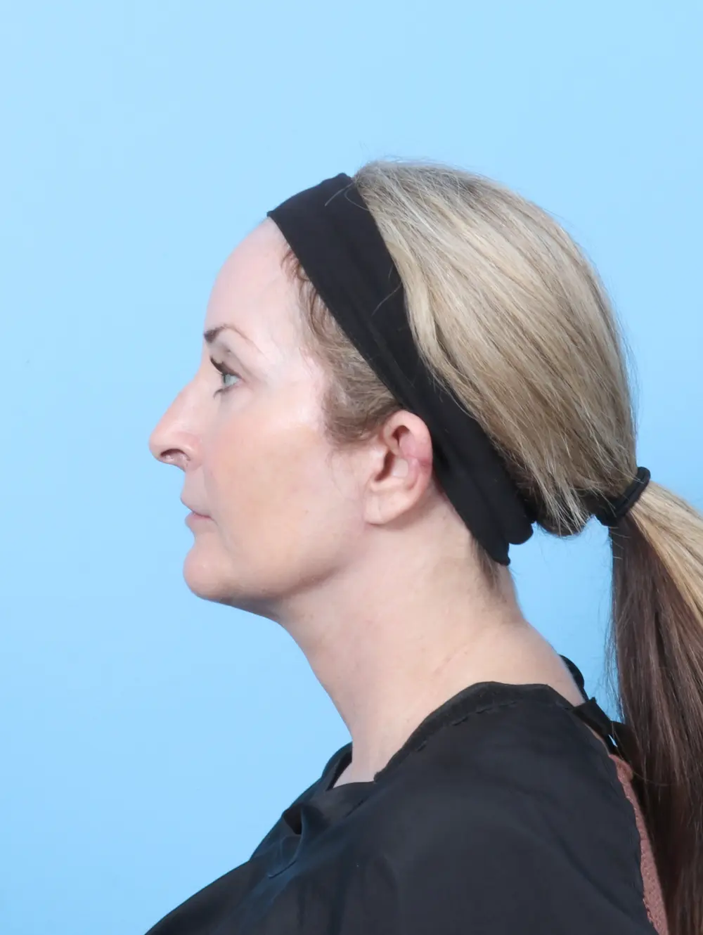 Bullhorn Lip Lift Patient Photo - Case 59761 - after view-2