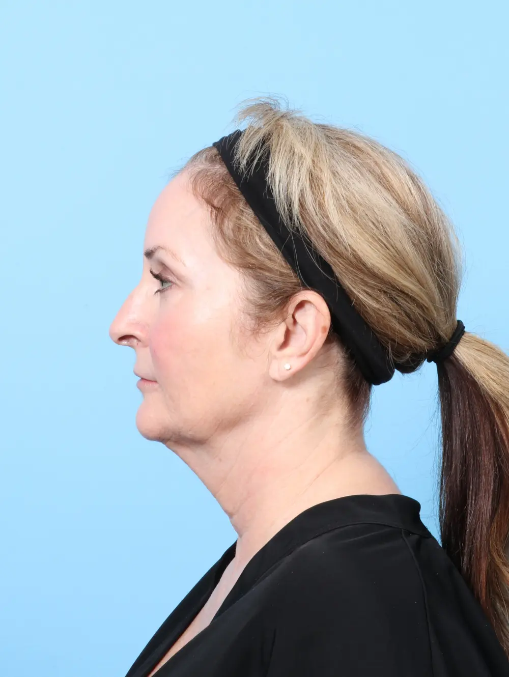 Bullhorn Lip Lift Patient Photo - Case 59761 - before view-2