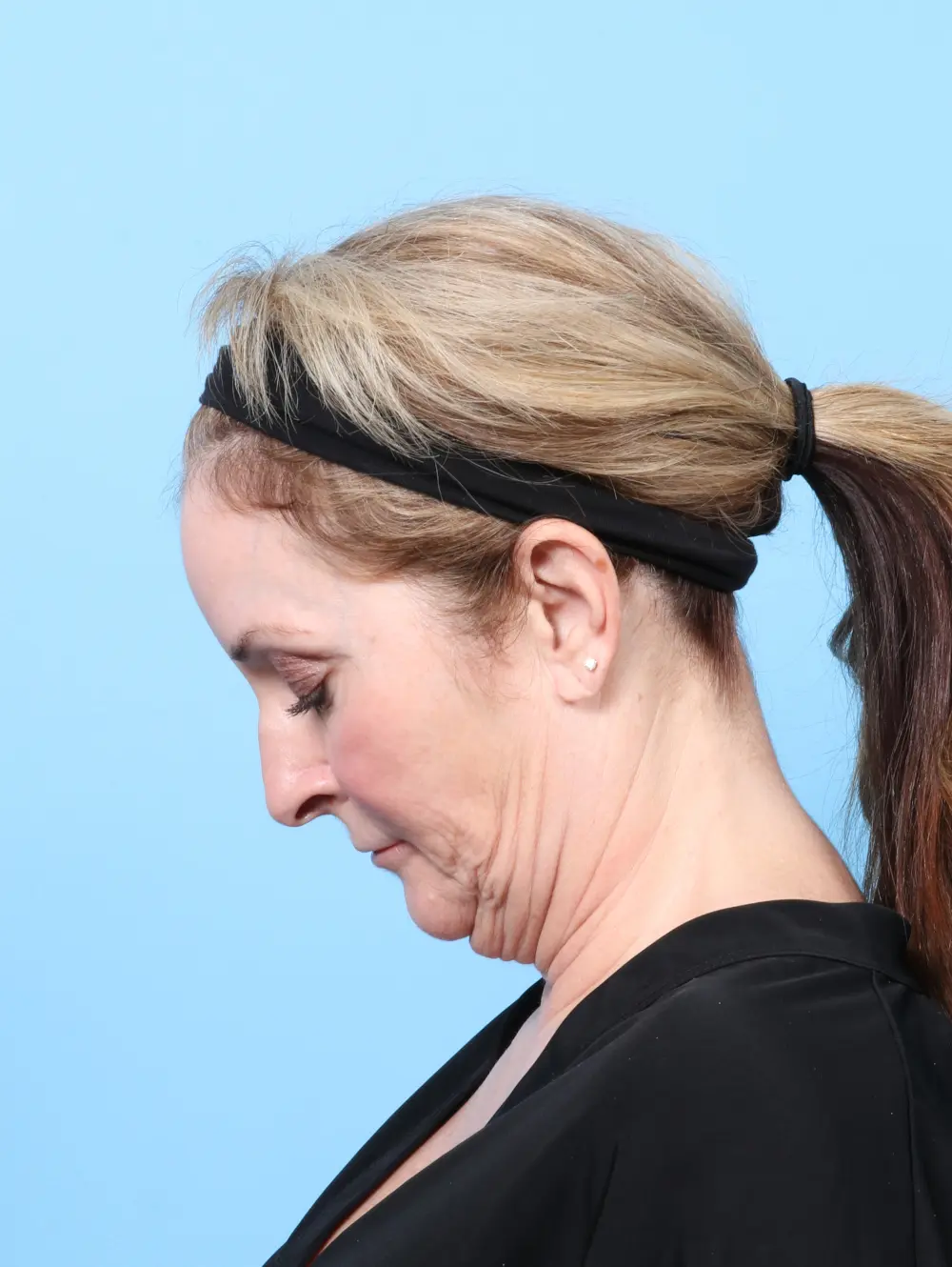 Bullhorn Lip Lift Patient Photo - Case 59761 - before view-3