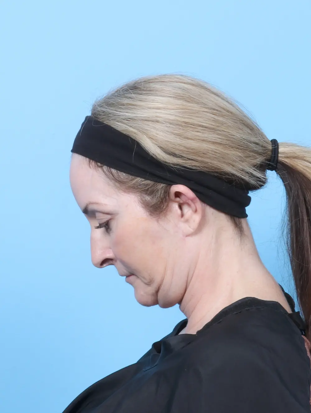 Bullhorn Lip Lift Patient Photo - Case 59761 - after view-3