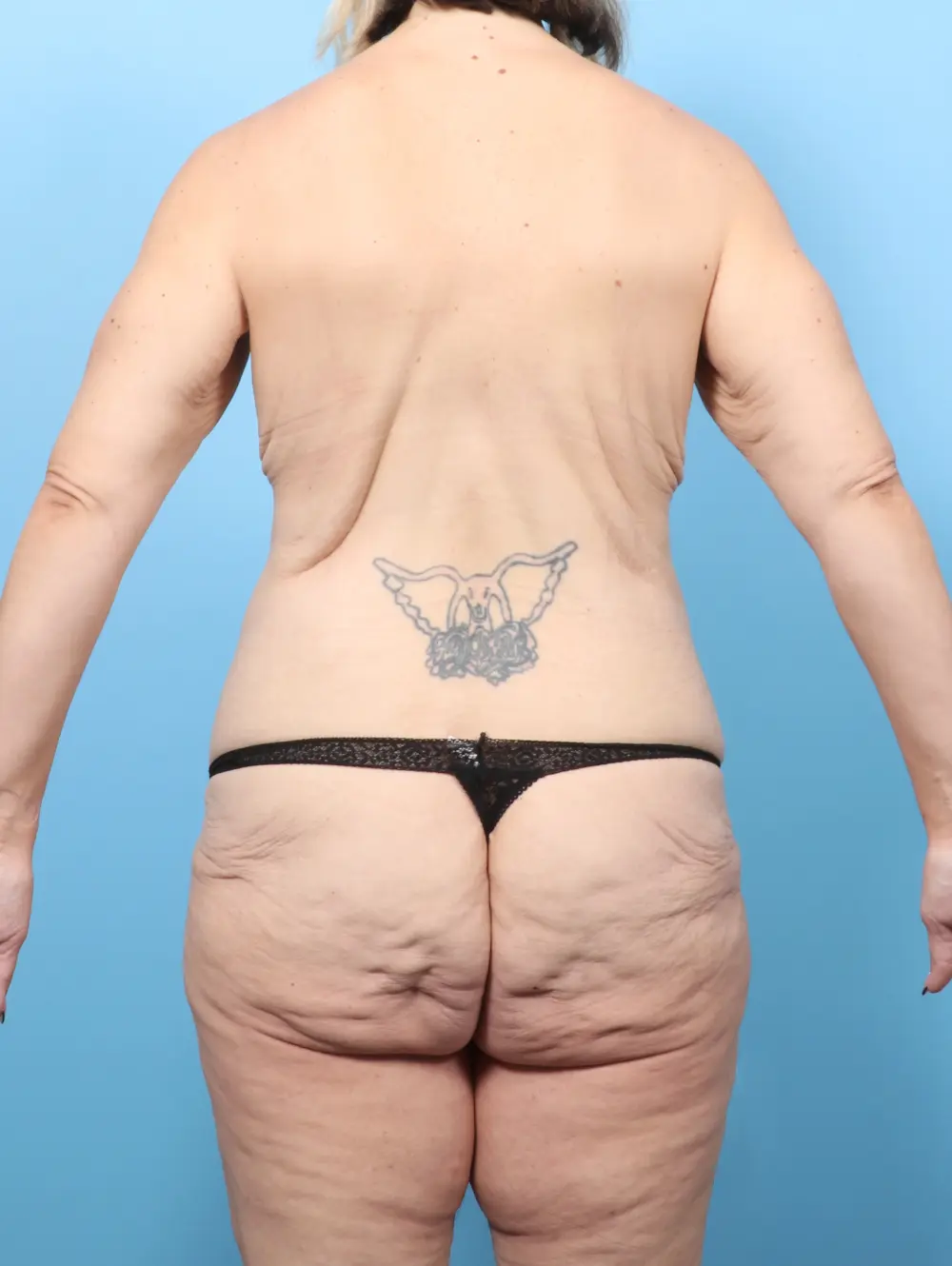 After Weight Loss Patient Photo - Case 59780 - before view-3