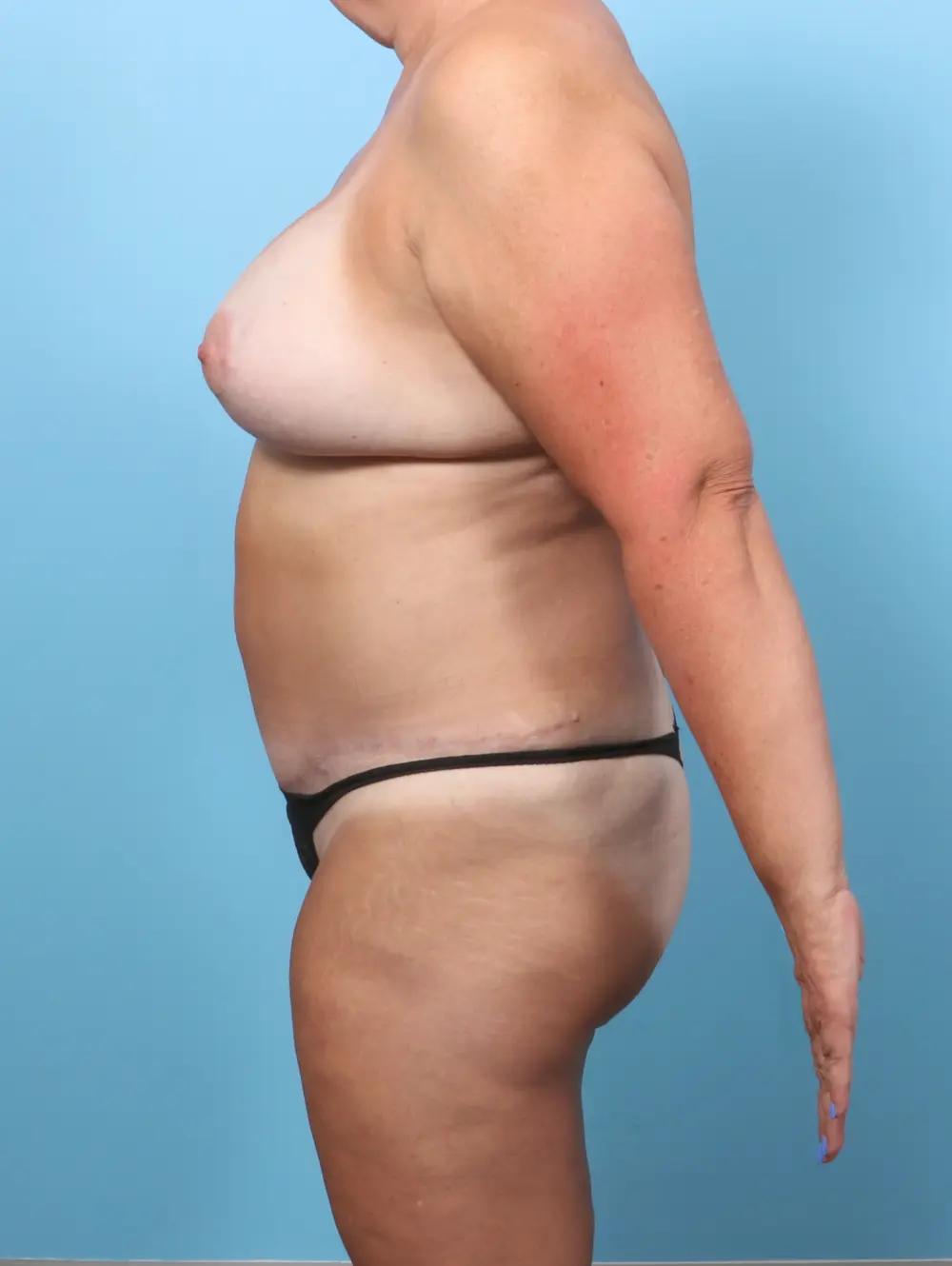Breast Lift/Reduction with Implants Patient Photo - Case 59790 - after view-2