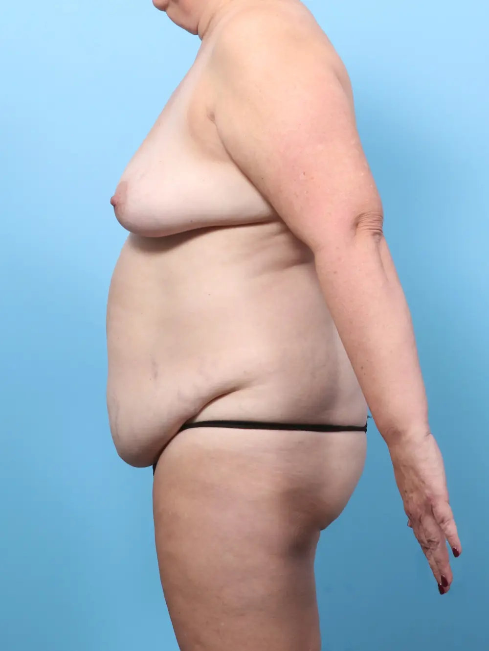 Breast Lift/Reduction with Implants Patient Photo - Case 59790 - before view-2