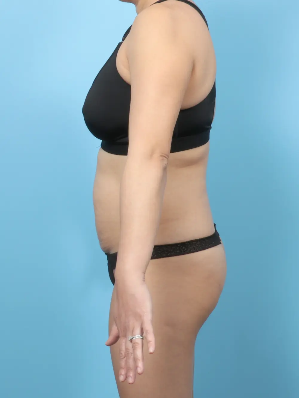Tummy Tuck Patient Photo - Case 59803 - before view-2