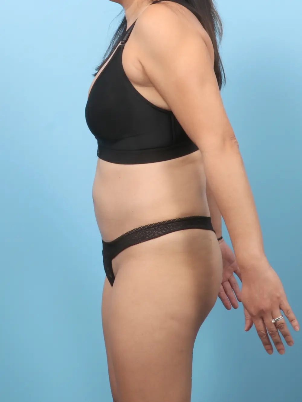 Tummy Tuck Patient Photo - Case 59803 - after view-2