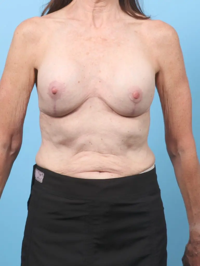 Breast Implant Revision - Case 59830 - After
