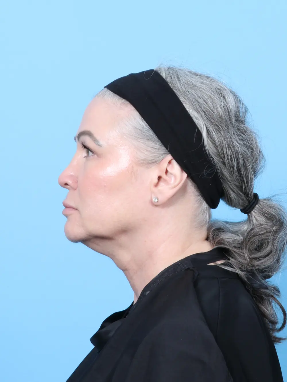 Eyelid Surgery Patient Photo - Case 59852 - before view-2