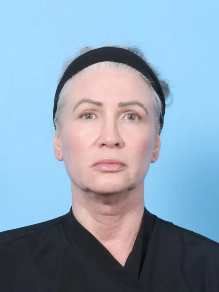 Eyelid Surgery - Case 59852 - After