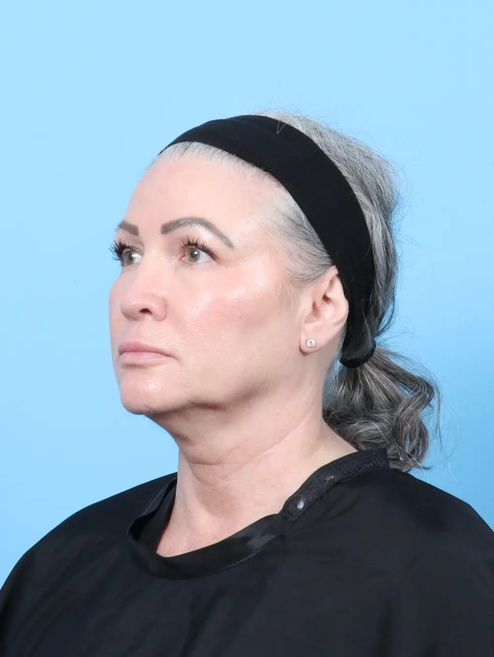 Eyelid Surgery Patient Photo - Case 59852 - before view-1