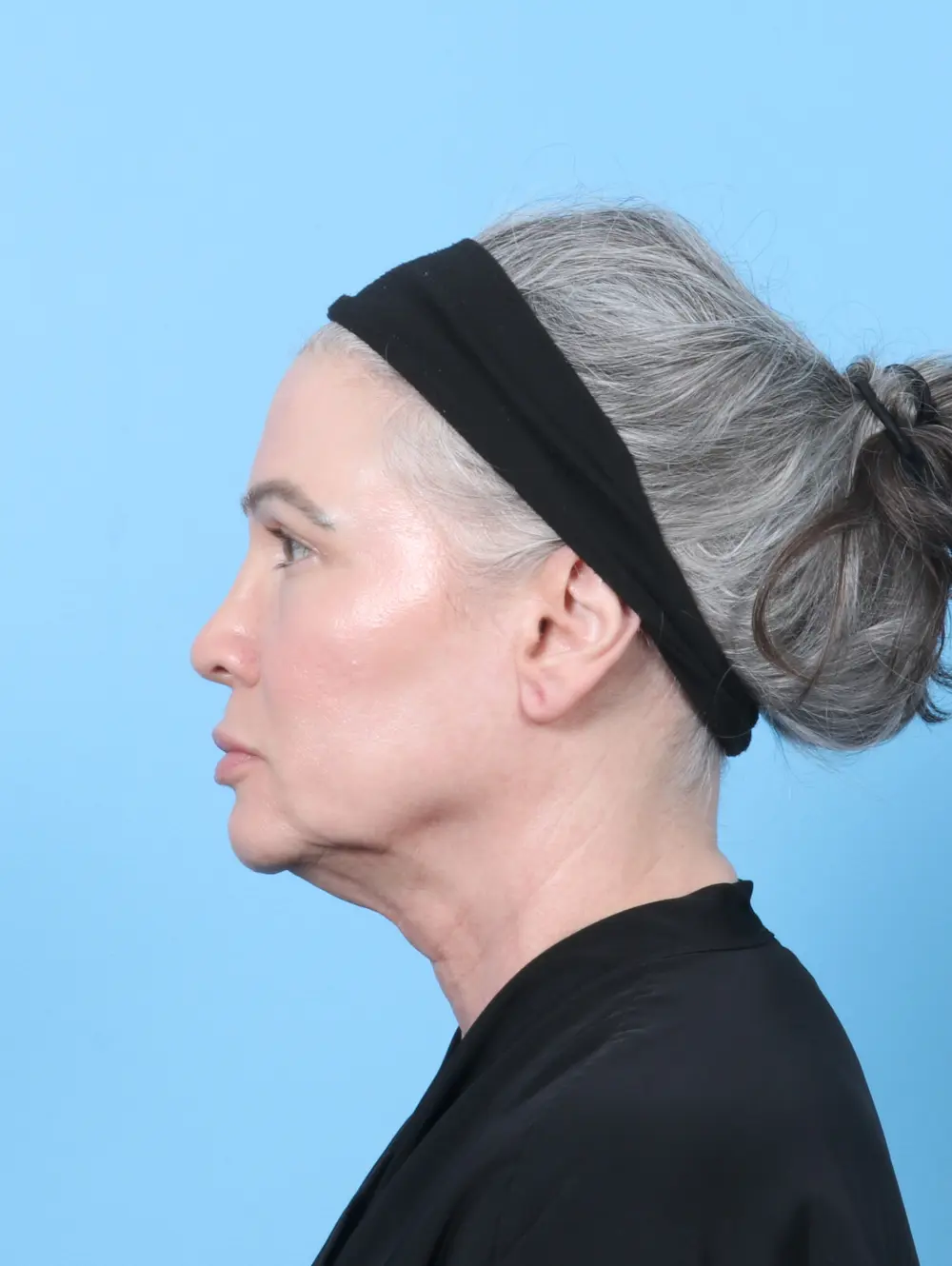 Eyelid Surgery Patient Photo - Case 59852 - after view-2