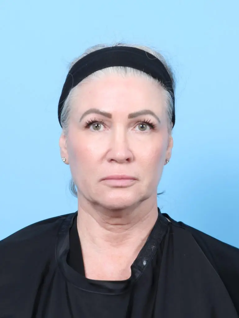 Eyelid Surgery - Case 59852 - Before