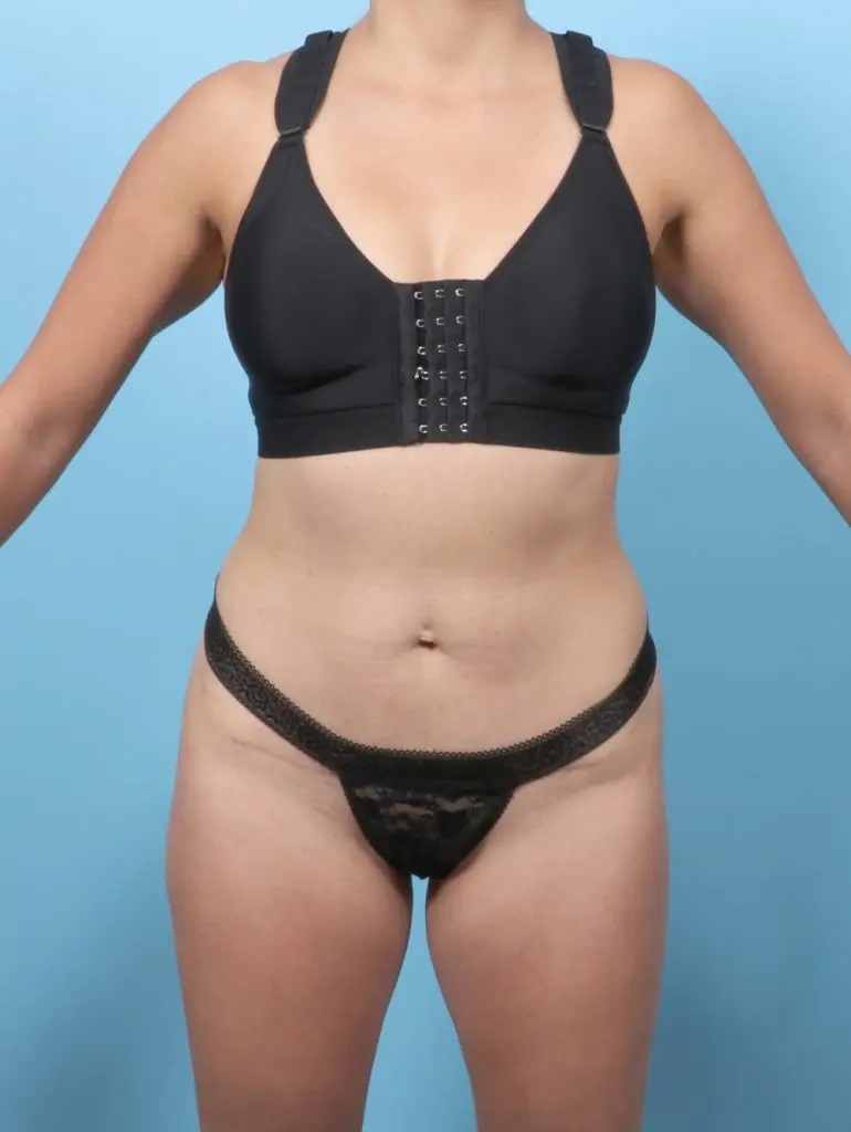 Liposuction - Case 59854 - After