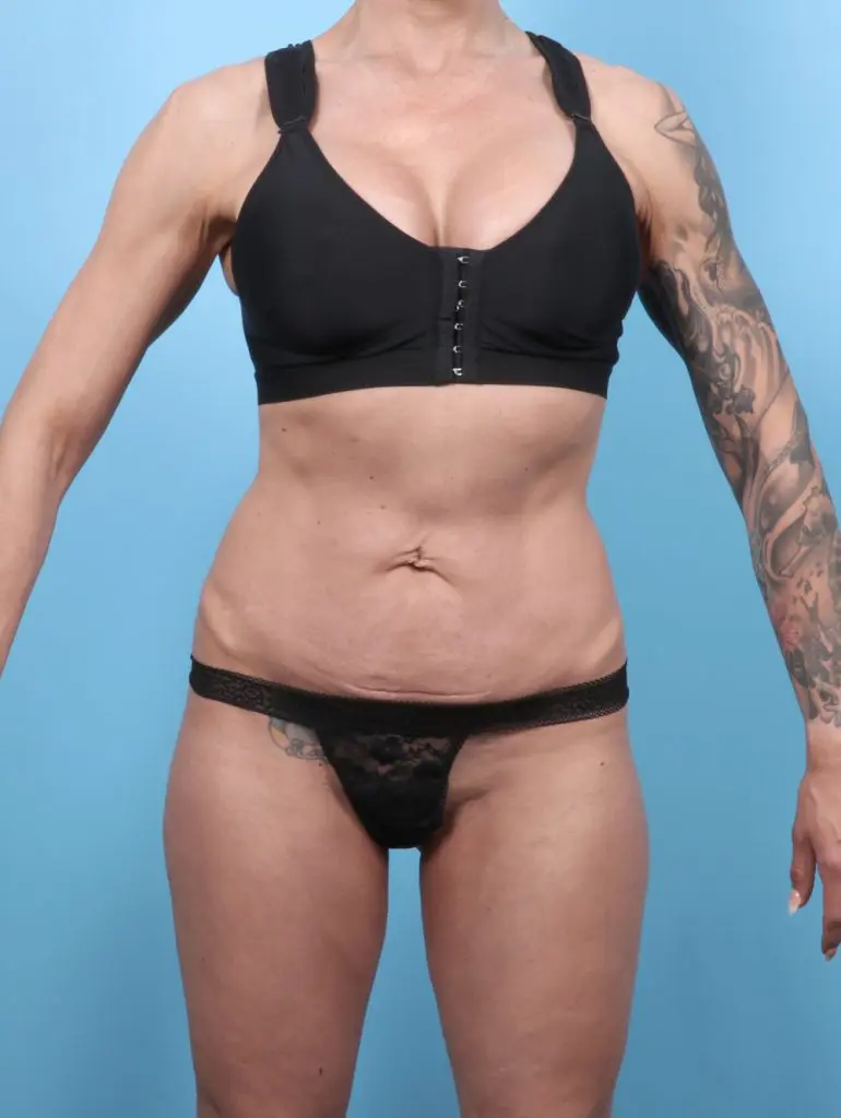 Tummy Tuck - Case 59870 - Before