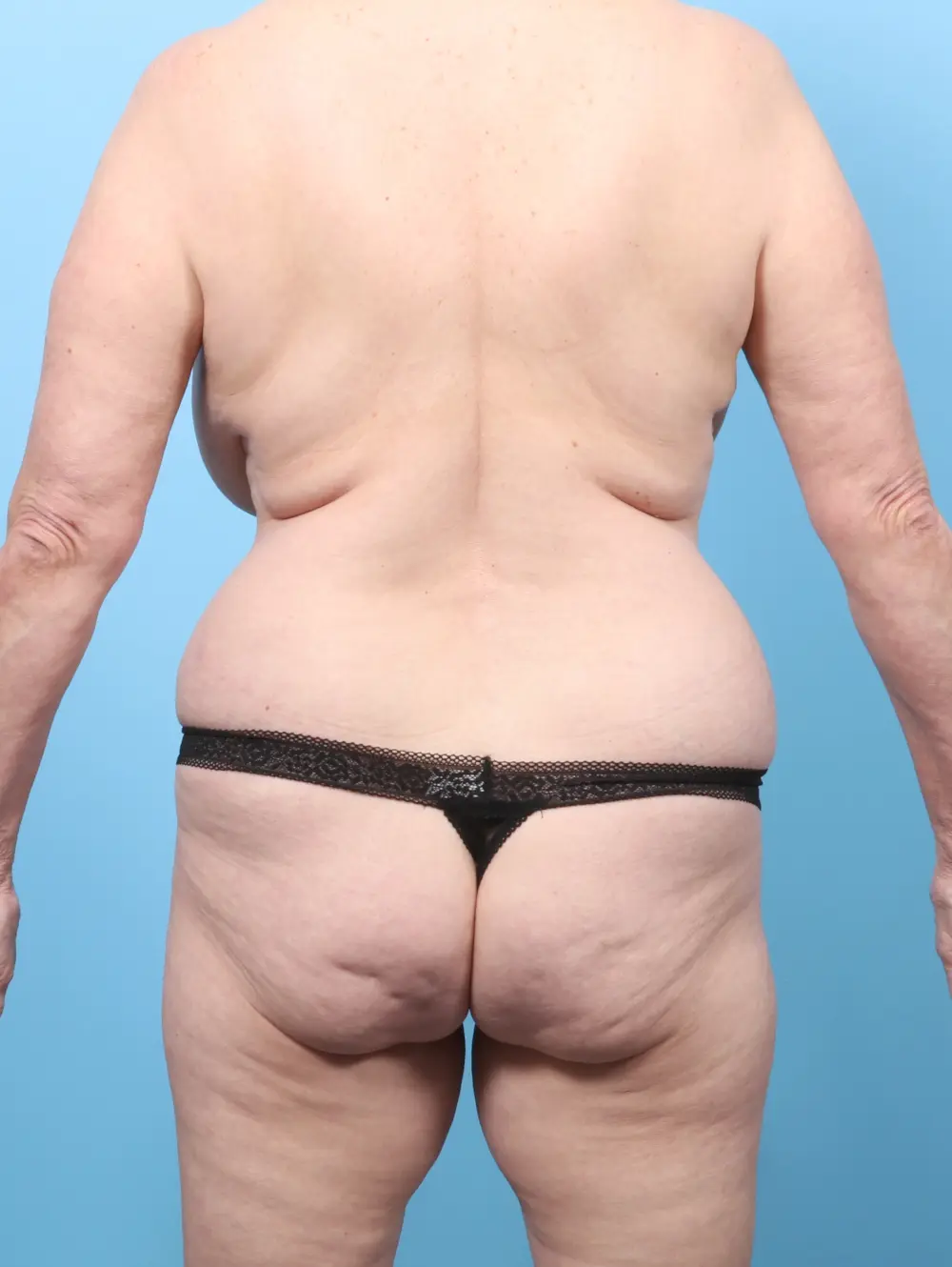 Breast Lift/Reduction w/o Implants Patient Photo - Case 59878 - before view-3